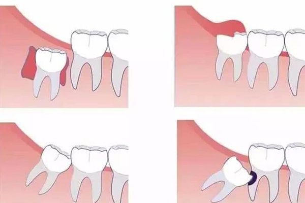 智齿长在肉里需要拔掉吗？中老年口
