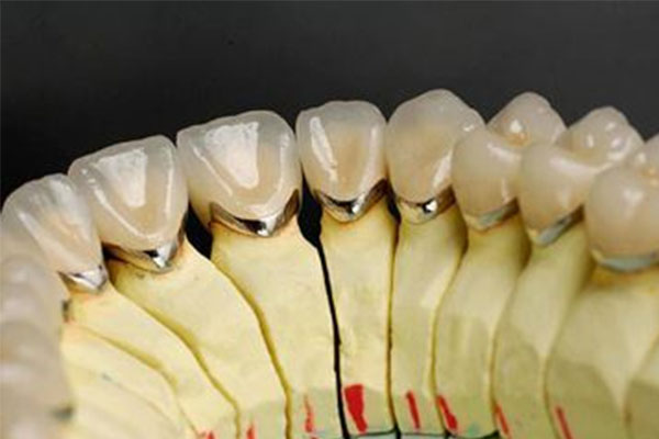 缺牙困扰？中老年口腔全瓷牙修复指南：价格透明，一颗仅需