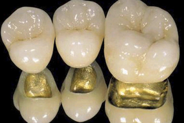 镶牙都用什么材料的牙套