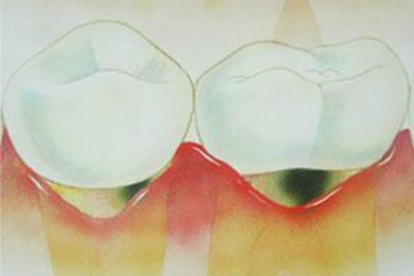 中老年口腔：补牙价格实惠，高效解决牙齿问题