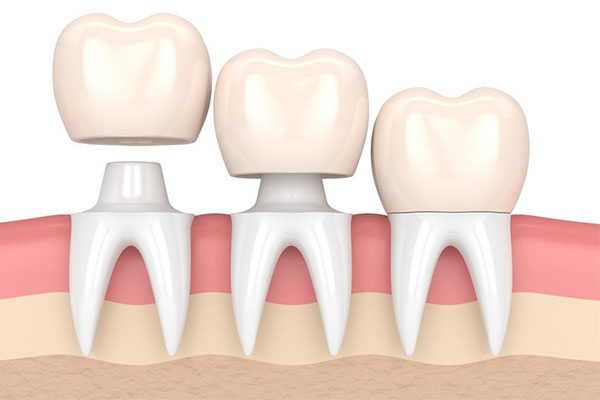 北京孩子补牙医保能报销吗？中老年口腔为您解答