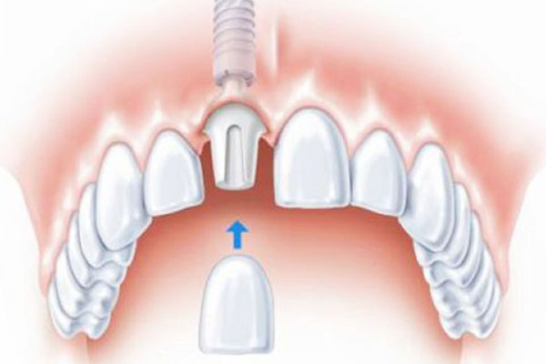 广东种牙多少钱一颗啊揭秘中老年口