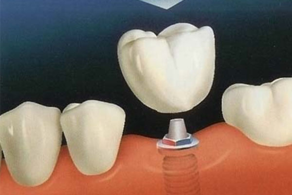 后槽牙拔了必须种牙吗多少钱一颗