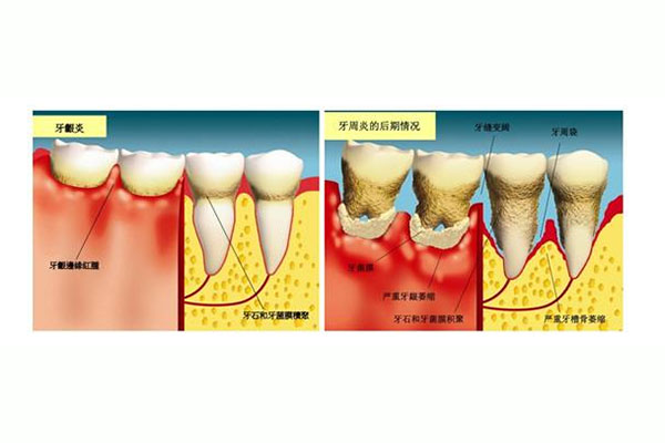 如何快速解决口腔溃疡、牙周炎、牙