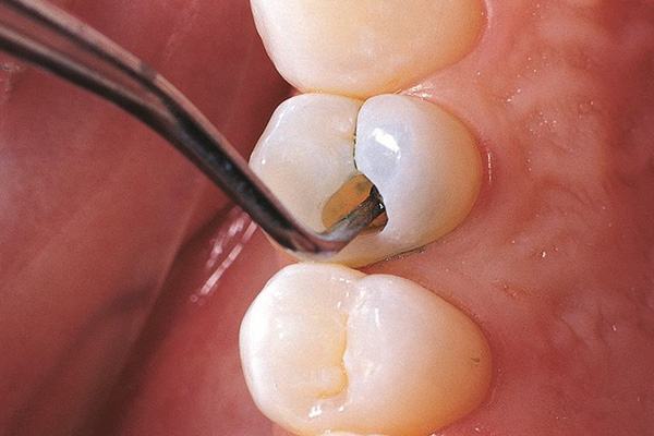 小孩牙洞必须补吗？中老年口腔专家