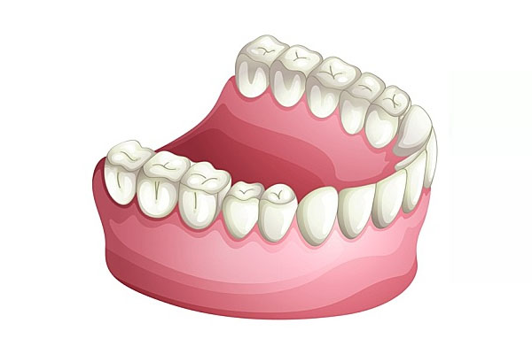 牙齿脱落是怎么回事？中老年口腔为