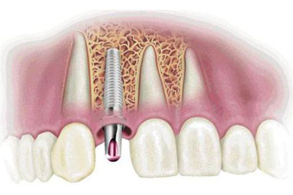 种牙最低价来袭中老年口腔批量修复缺牙效率翻倍