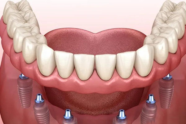老年人种牙价格是多少？中老年口腔为您解答