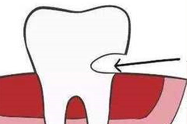 西安交大口腔医院补牙费用及保险报销全解析，中老年补牙更省