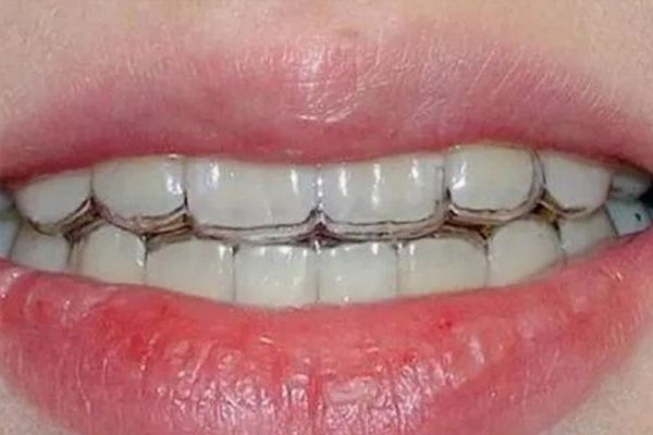 40岁矫正牙齿的危害及中老年口腔的专