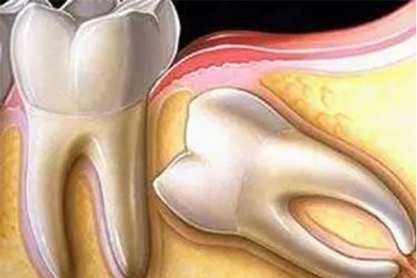 拔完智齿之后嘴张不开？中老年口腔专家支招快速恢复张嘴自由