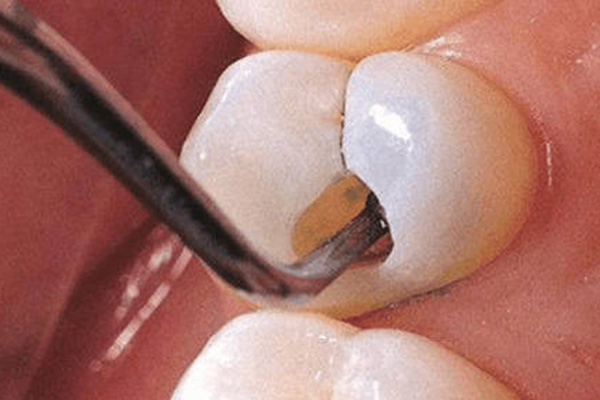 门牙补牙多少钱？中老年口腔为您解