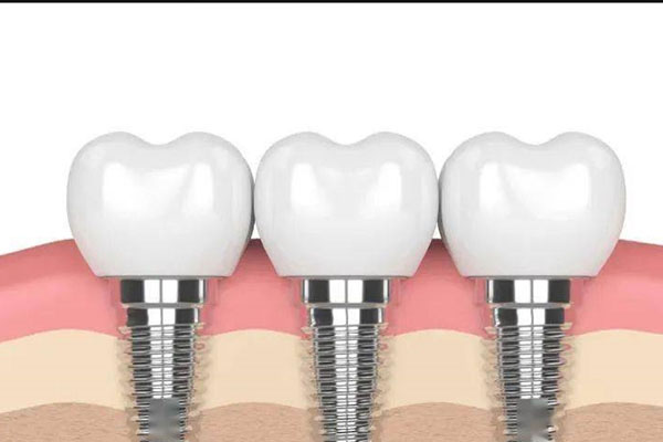 中老年缺牙患者必看：镶烤瓷牙和种