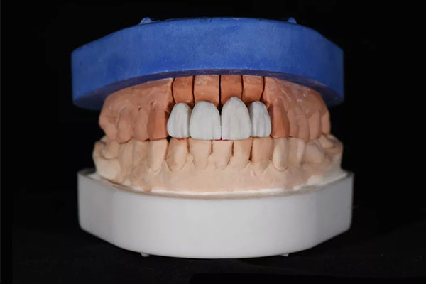 老年人安装活动假牙是靠什么固定