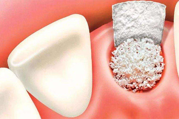 城乡居民医保补牙能报销吗？中老年