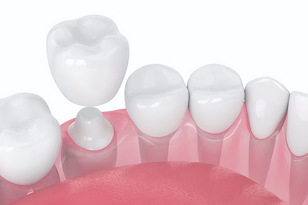 种牙好还是烤瓷牙呢 中老年口腔批量