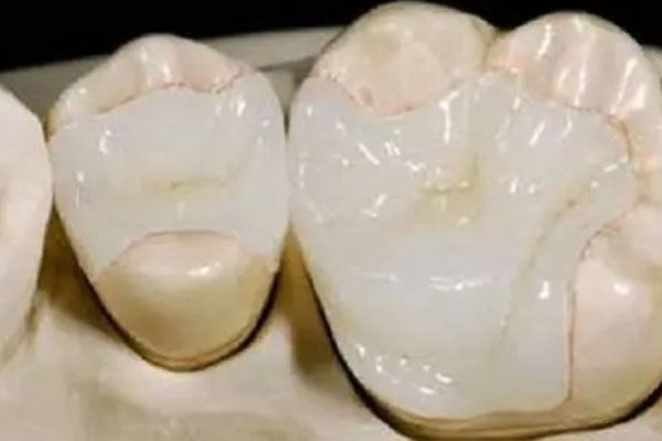 钛合金活动义齿支架：专为中老年设