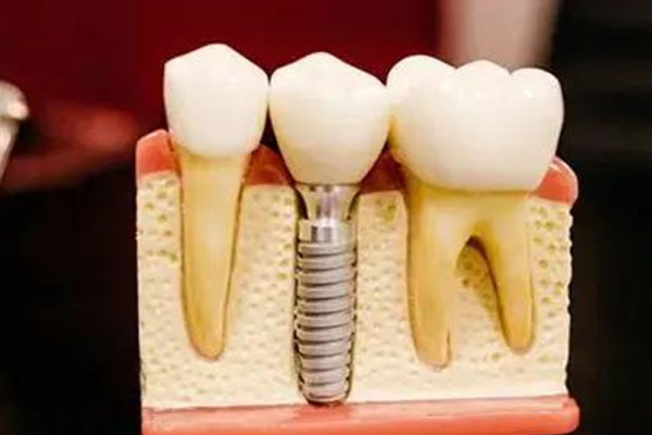 安哪种牙齿好些中老年口腔批量种植牙效率高质量好