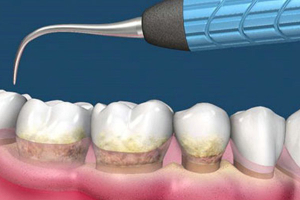 洗牙清理牙结石后咬不动？中老年口