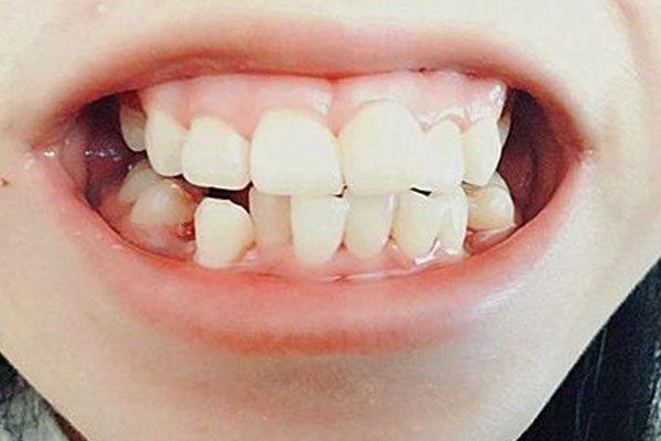 牙齿松动变软怎么回事？中老年口腔为您解析原因与高效解决方