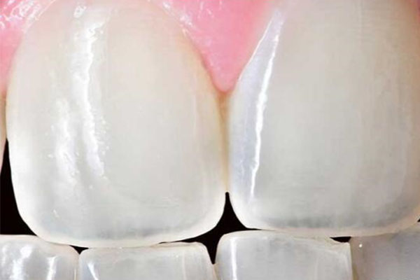 牙髓炎怎么弄的？中老年口腔批量修复技术让缺牙不再困扰