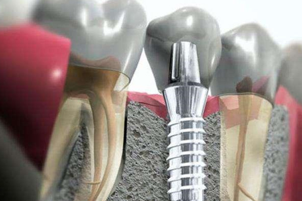 种牙公费医疗能报销吗？中老年口腔为您解答并提供高效解决方