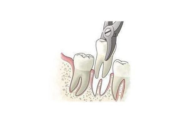 拔牙后几天能正常吃饭？中老年口腔为您揭秘科学恢复周期