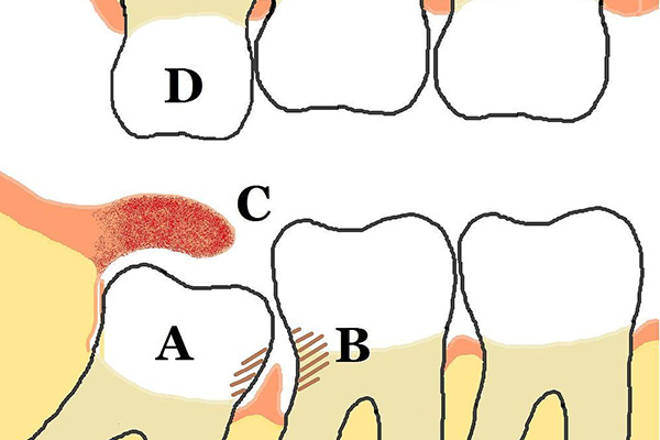 拔智齿为什么不能碰中老年口腔提醒