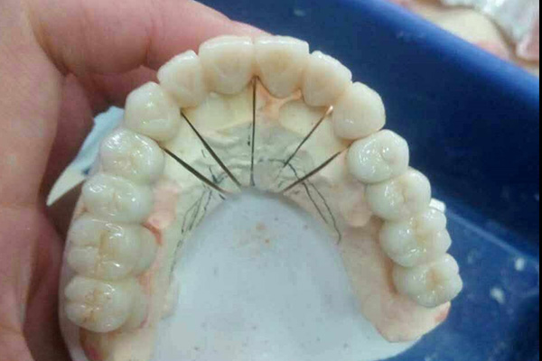 钴铬烤瓷牙牙套多少钱？中老年口腔