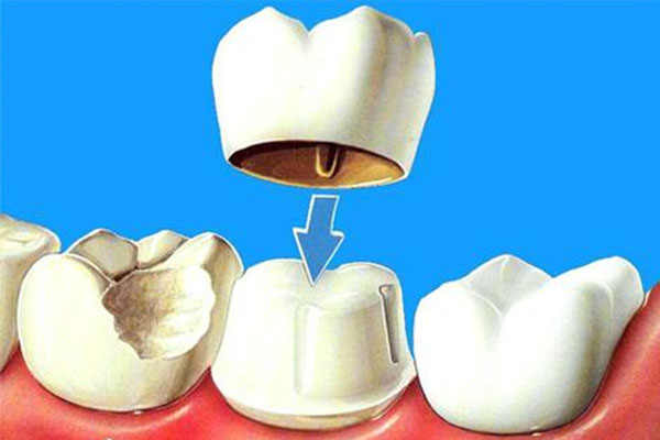 西安补牙价格多少？中老年口腔为您