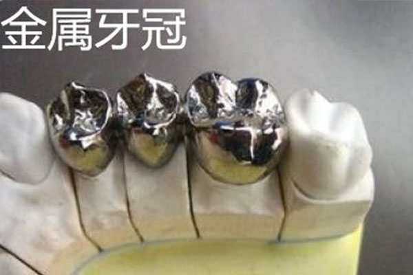 假牙烤瓷 vs 不锈钢：哪种更适合中老