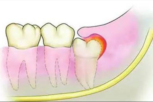 拔智齿金额别花冤枉钱，中老年口腔批量种牙更划算