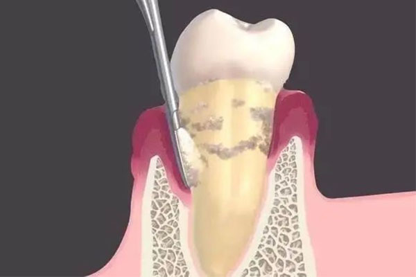 两颗牙脱落到底算不算轻伤？中老年口腔为您快速解决牙齿缺失