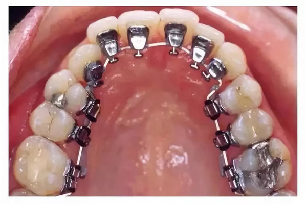 中老年口腔揭秘：活动义齿材质全解析 选对材质不踩坑