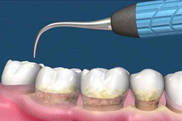 过敏性牙齿洗牙总出血？中老年口腔