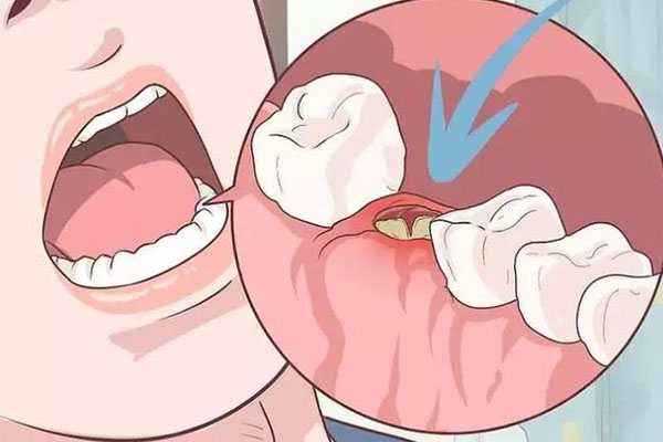 中老年口腔：根管治疗到底多少钱？