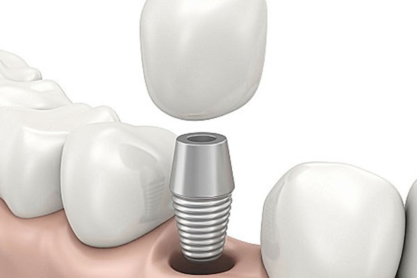 种牙牙根是什么材质的？中老年口腔