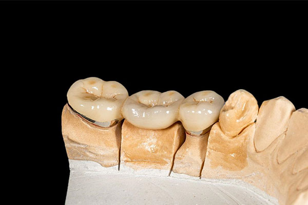 全瓷冠怎么做？中老年口腔3天批量修复20颗缺牙的实战攻略