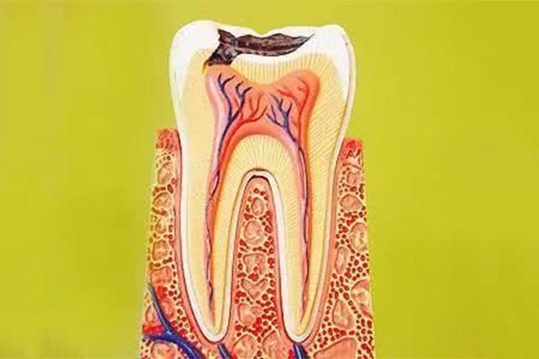 宝宝防蛀牙要做什么手术