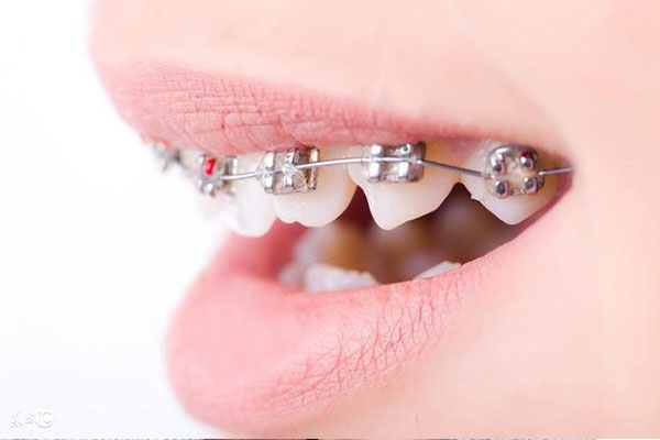 30岁后牙齿矫正还来得及吗？中老年口