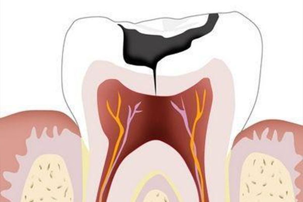中老年口腔：蛀牙掉完了也能轻松装假牙，缺牙不再是难题！