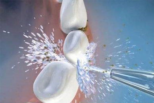 洗牙多少钱一次？中老年口腔批量护