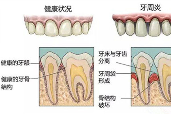 牙周炎牙龈肿痛用什么牙膏好？中老
