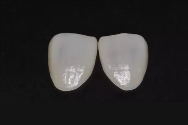 牙贴面取下后的牙齿(牙贴面取下后的牙齿疼)