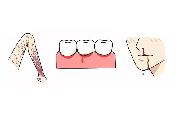 刷牙时老是牙龈出血