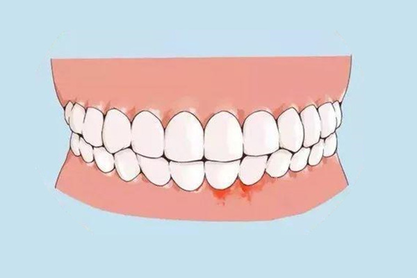 刷牙时牙龈老是出血怎么治疗