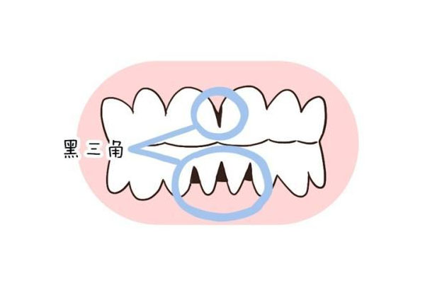 年轻人为什么牙龈萎缩(年轻人为什么牙龈萎缩呢)