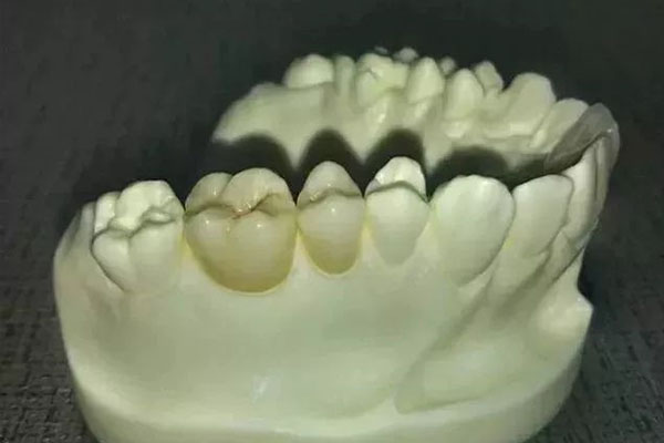 什么叫义齿内染色(义齿染色流程)