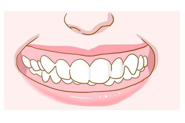 地包天多久能矫正好(地包天矫正多久有效果)