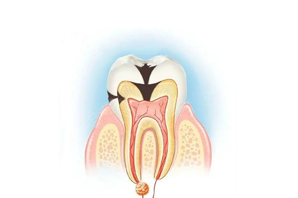 儿童补牙一般能保持多久(儿童补牙能坚持多久不掉)